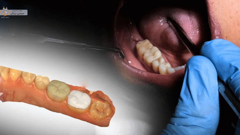 آیا پر کردن دندان درد دارد