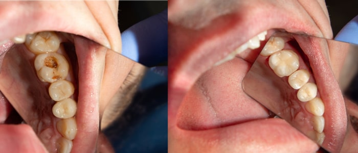 آیا پر کردن دندان درد دارد