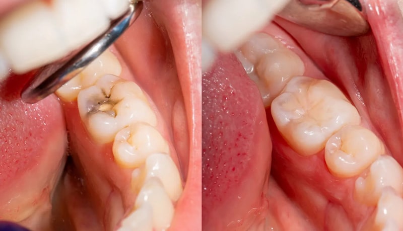 درد دندان بعد از پر کردن