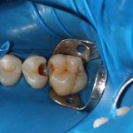 طول عمر دندان پر شده چقدر است