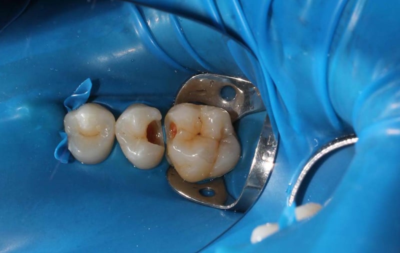 طول عمر دندان پر شده چقدر است