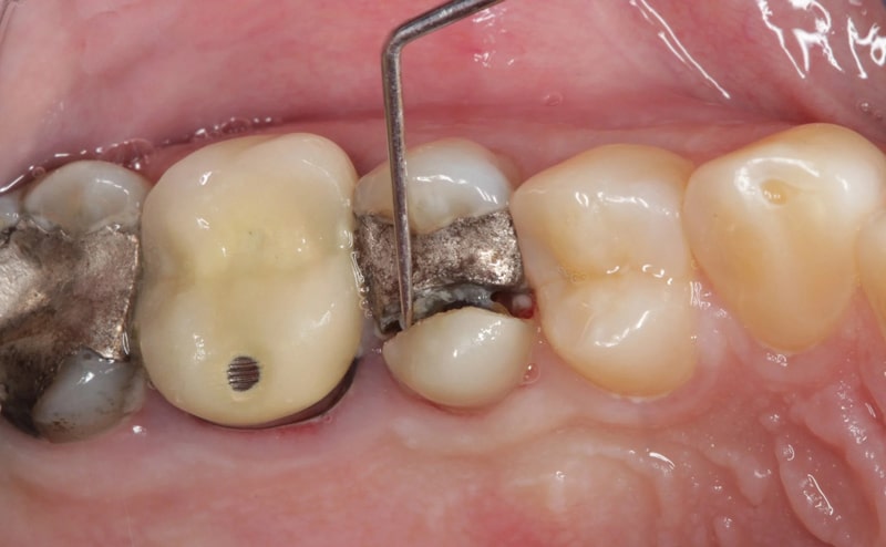 افزایش طول عمر دندان پر شده