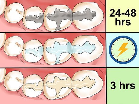 مراقبت های بعد از پر کردن دندان