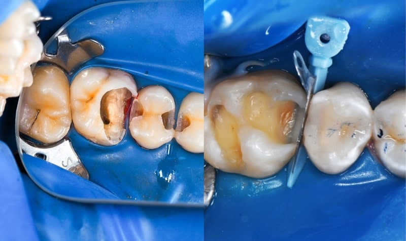 مراقبت بعد از پر کردن دندان
