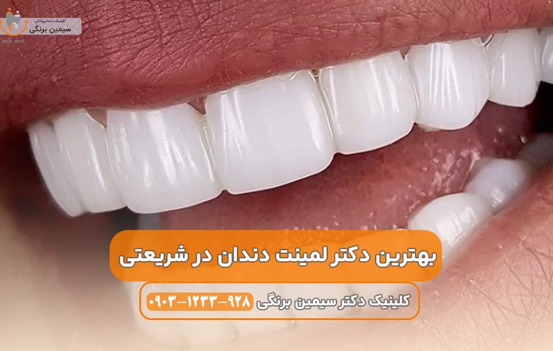 بهترین دکترلمینت در تهران شریعتی