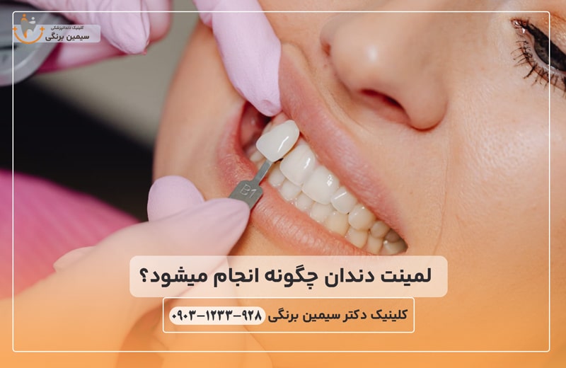لمینت دندان چگونه انجام میشود