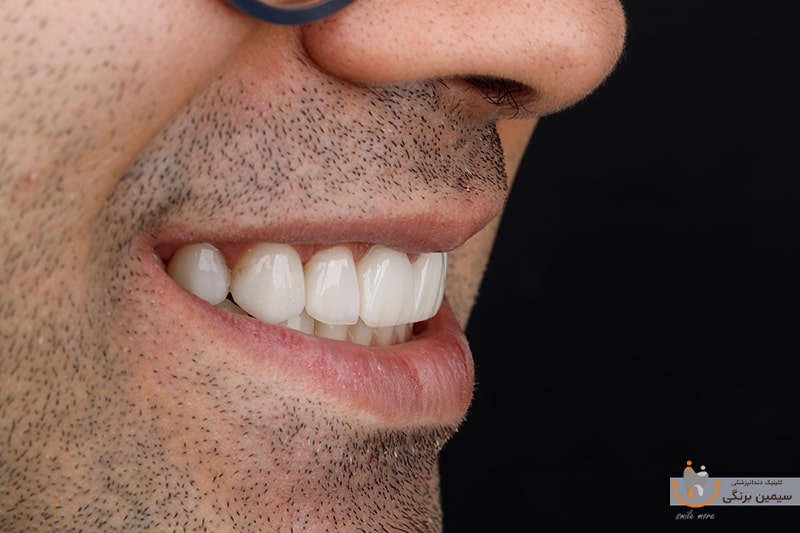 لمینت دندان