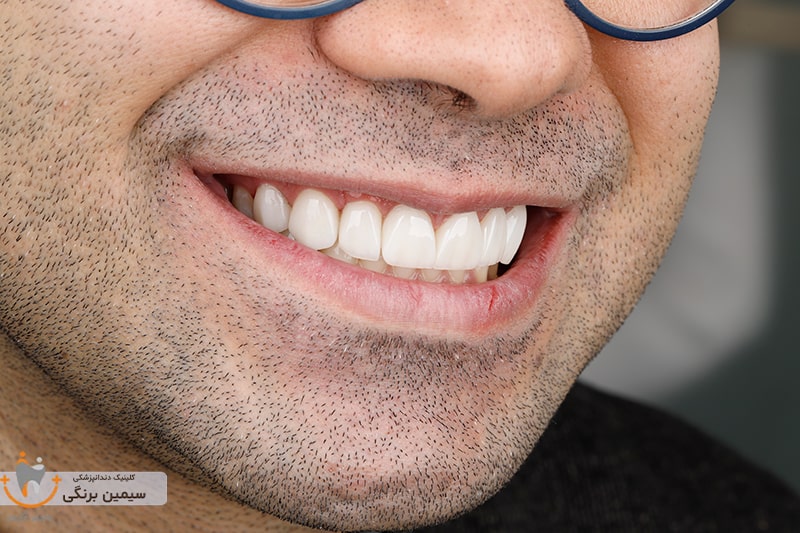 عکس لمینت دندان