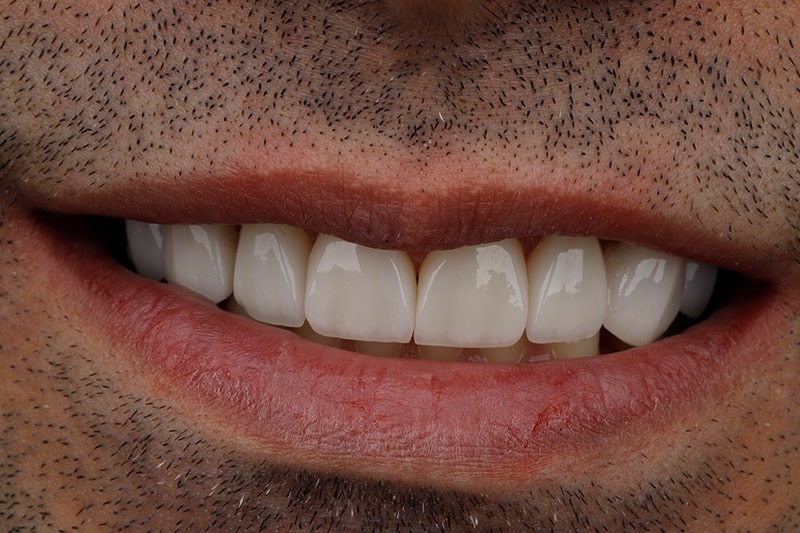 لمینت دندان چگونه انجام میشود