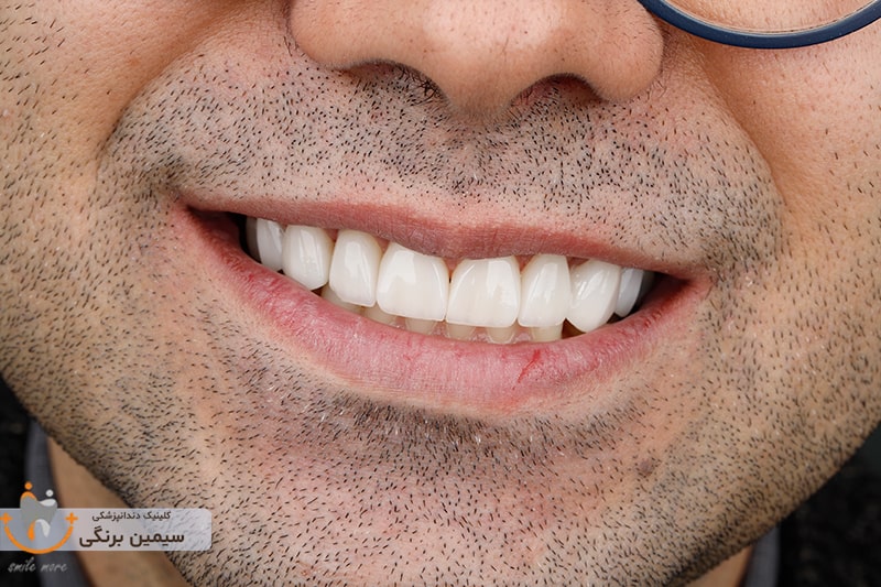 لمینت دندان طبیعی