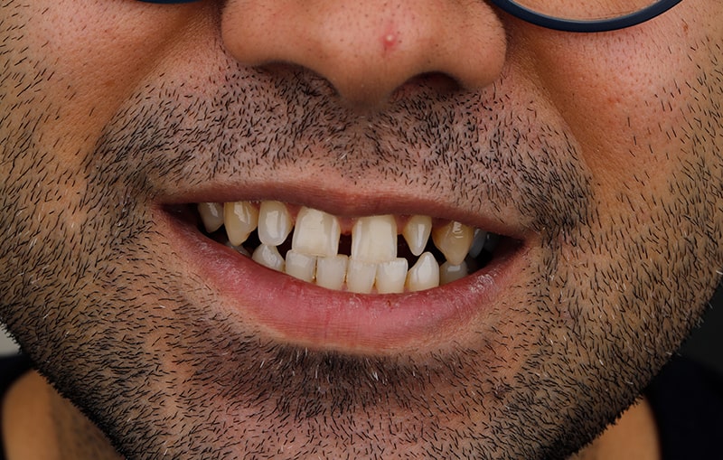 لمینت طبیعی