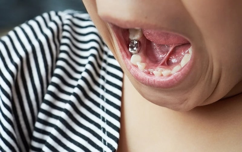 پرکردن دندان کودکان