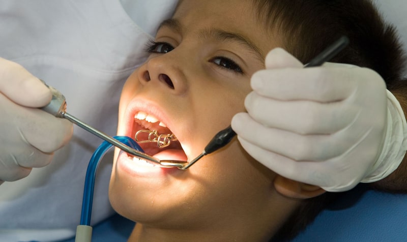 پرکردن دندان کودکان