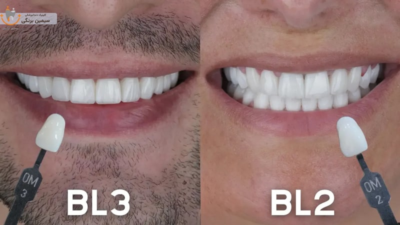 کامپوزیت سفید صدفی