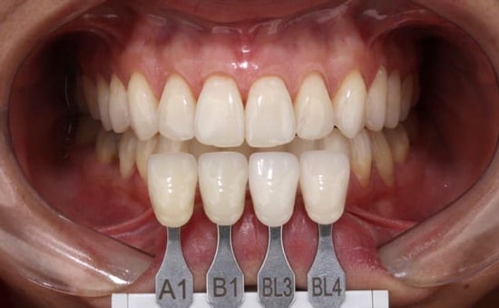 سفید ترین رنگ کامپوزیت دندان