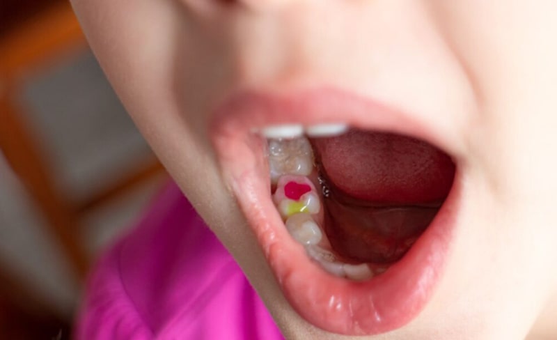 پر کردن و ترمیم دندان شیری