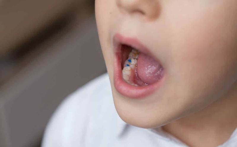 پرکردن دندان کودک 4 ساله