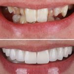 کامپوزیت دندان خرگوشی قبل و بعد