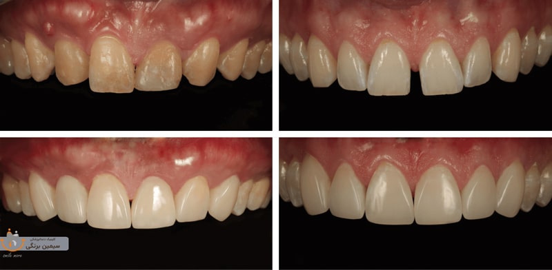 کامپوزیت دندان های کج