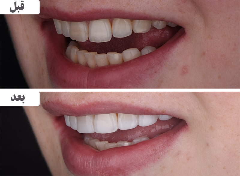 کامپوزیت دندان کج