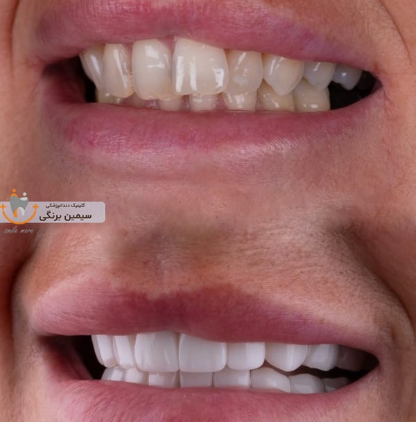 کامپوزیت برای دندان کج