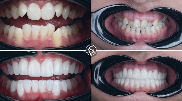 چه افرادی گزینه مناسبی برای کامپوزیت دندان کج هستند؟