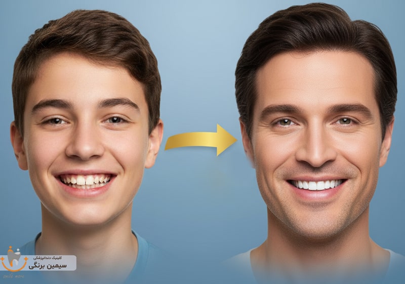 بهترین سن لمینت دندان