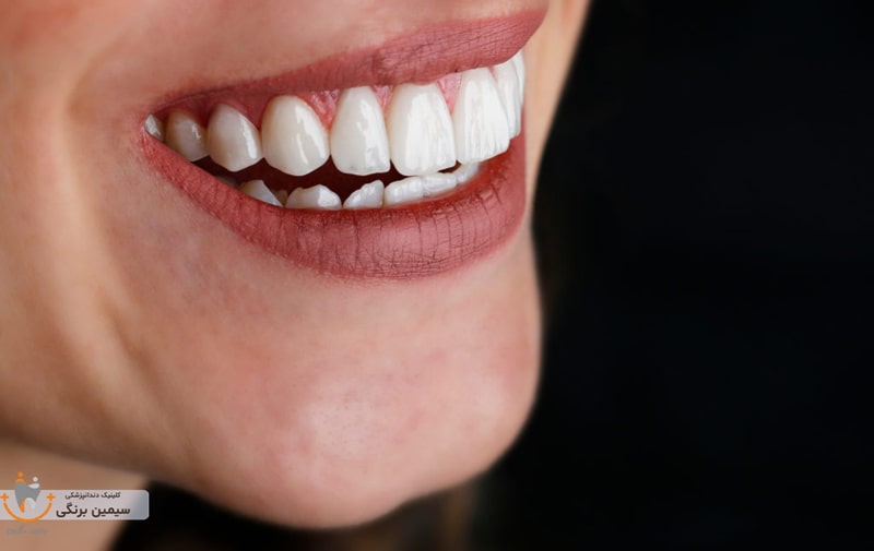 بهترین سن لمینت دندان