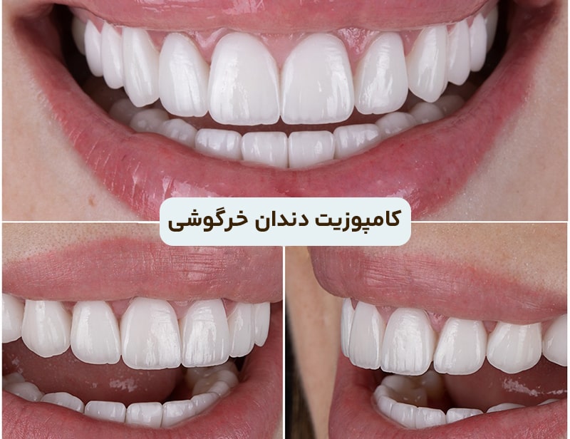 کامپوزیت دندان خرگوش