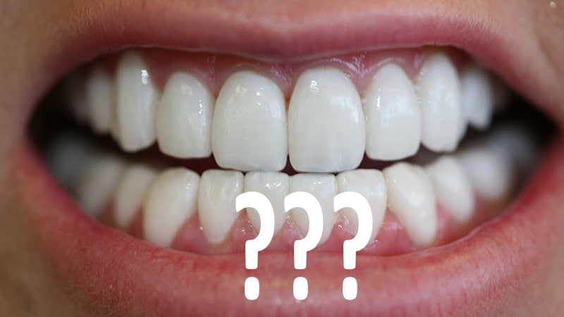 معایب کامپوزیت دندان