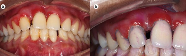 معایب کامپوزیت دندان