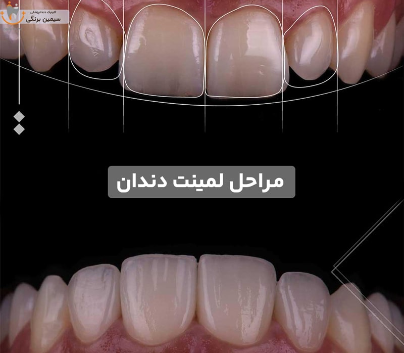 مراحل لمینت دندان