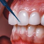 مراحل امینت دندان چگونه است