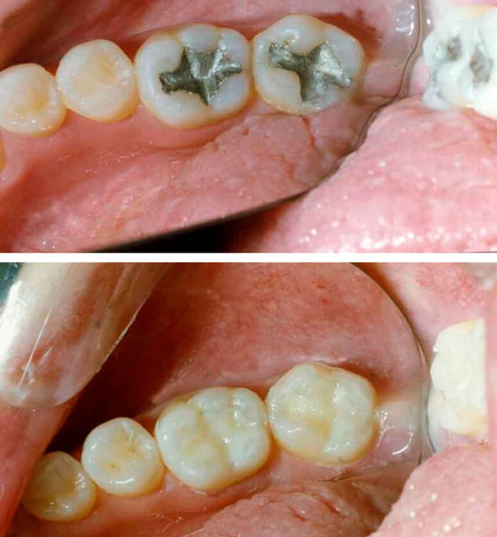 فرق ترمیم و پرکردن دندان