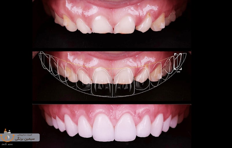 مراحل لمینت دندان با عکس