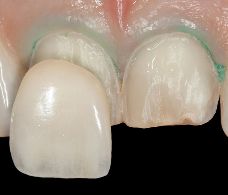 فیلم مراحل لمینت دندان