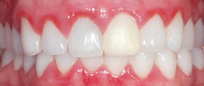 آیا دندانها بعد از لمینت حساس می شوند؟