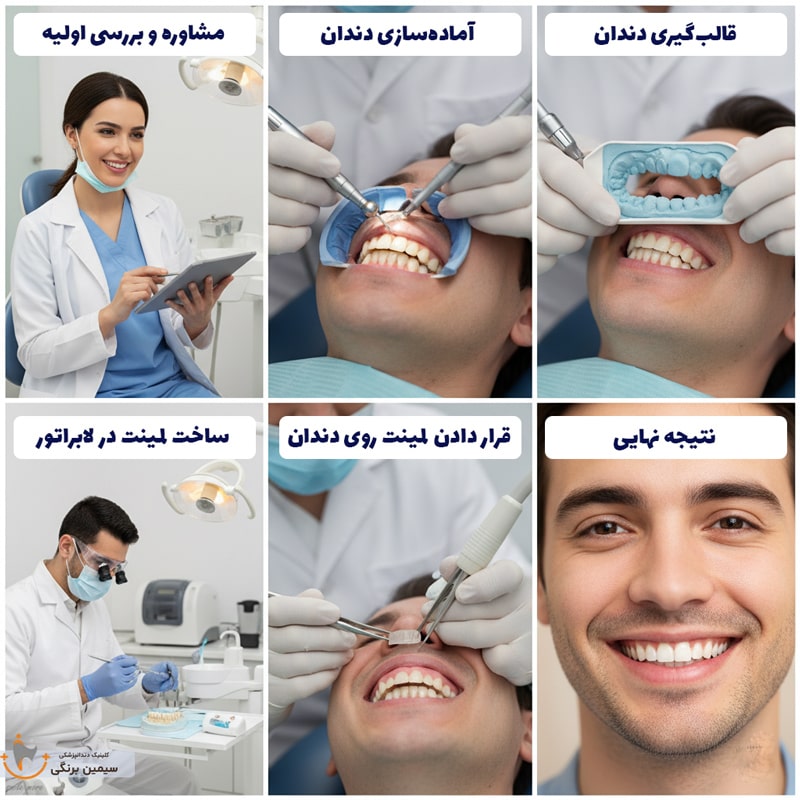 مراحل لمینت دندان با عکس