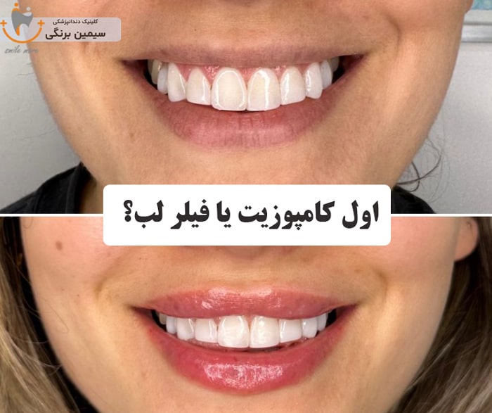 اول کامپوزیت یا فیلر لب