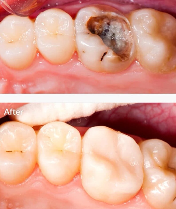 فرق ترمیم و پرکردن دندان