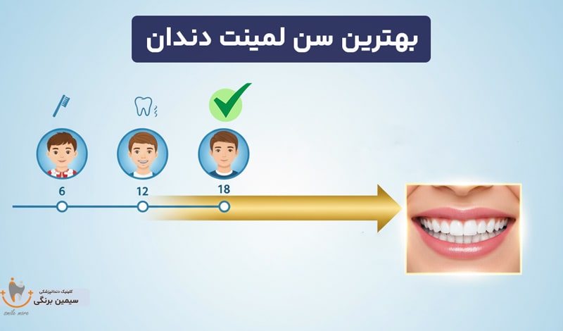 بهترین سن لمینت دندان