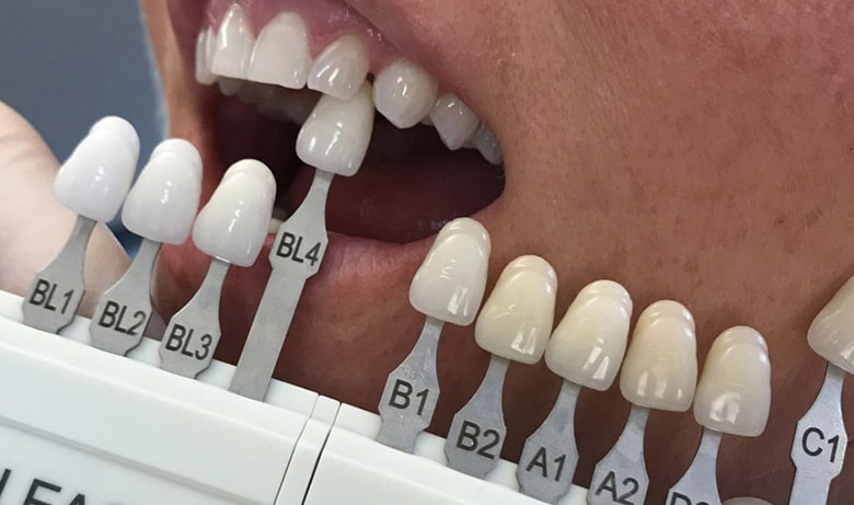 بهترین ترین رنگ های لمینت دندان