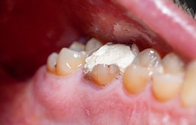 پرکردگی موقت دندان چیست؟