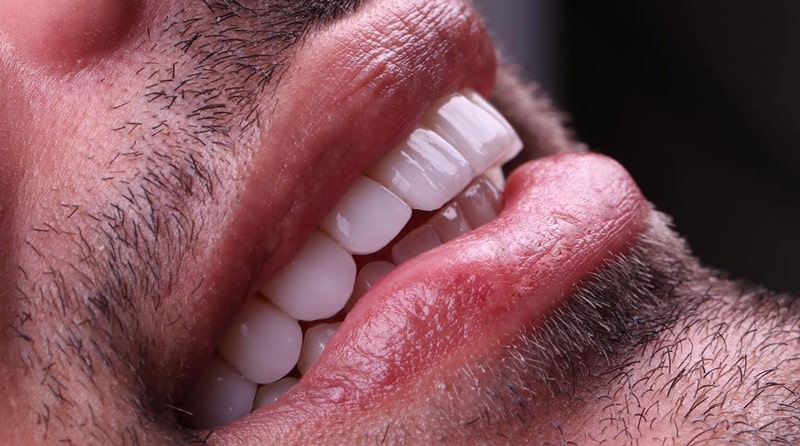 روکش های لمینت ایمکس