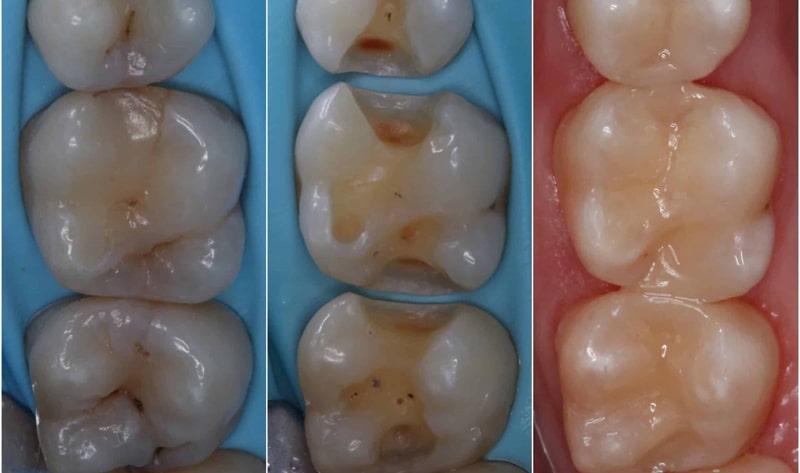 علت ریختن مواد دندان پر شده