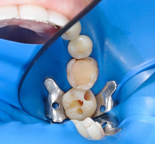 ریختن دیواره دندان پر شده