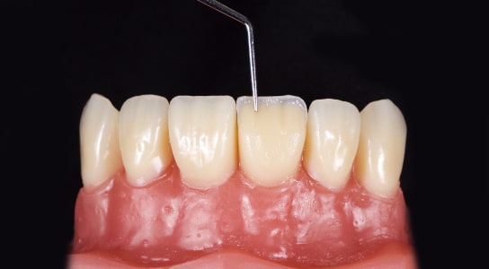 ضخامت کامپوزیت دندان چقدر است؟ 