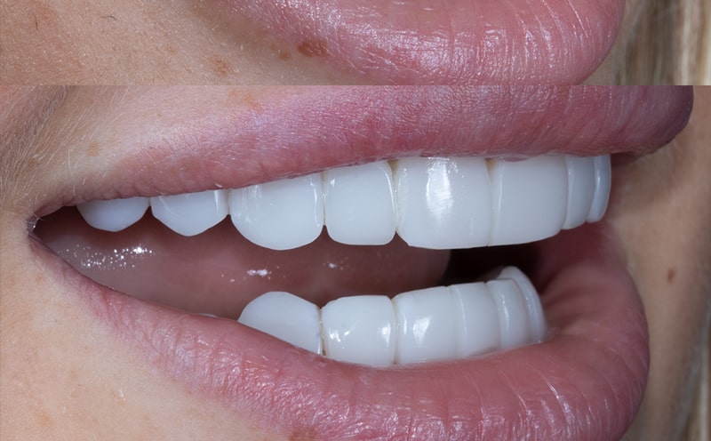 علت جلو آمدن دندان بعد از کامپوزیت