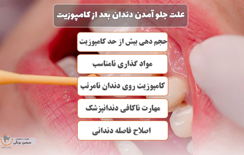 علت جلو آمدن دندان بعد از کامپوزیت