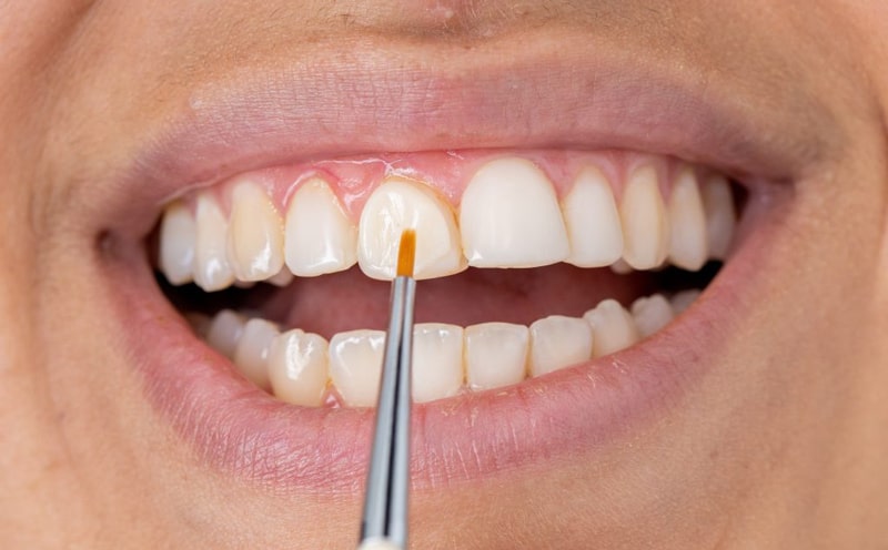 کامپوزیت دندان چقدر طول میکشد